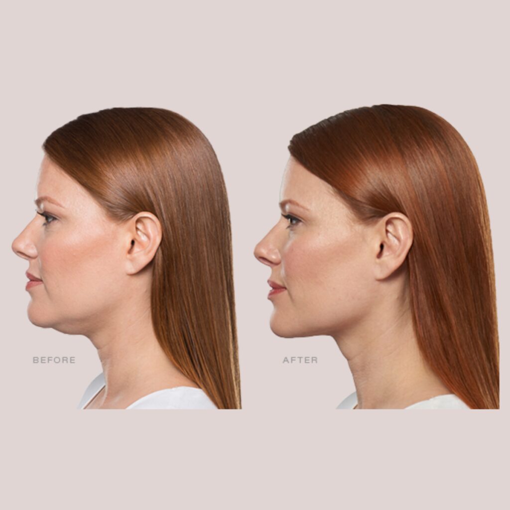 Kybella