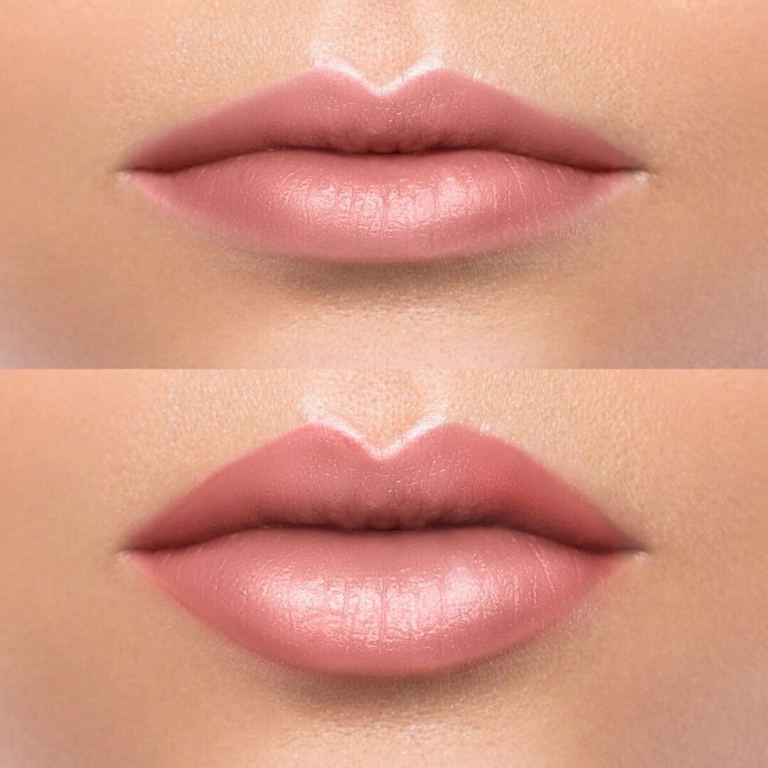Lip Fillers
