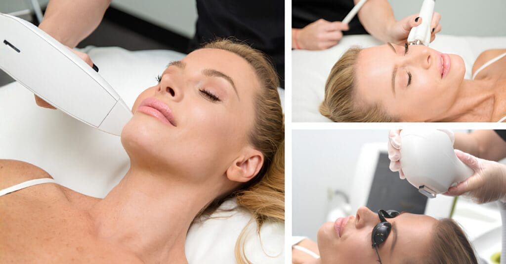 IPL Photofacial