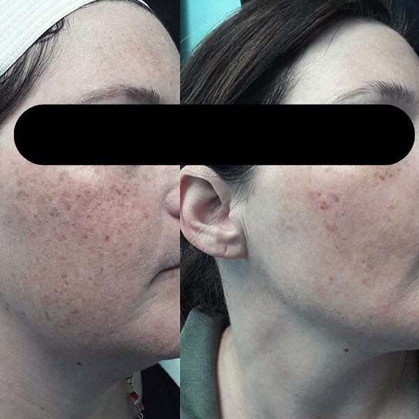 IPL Photofacial Blog