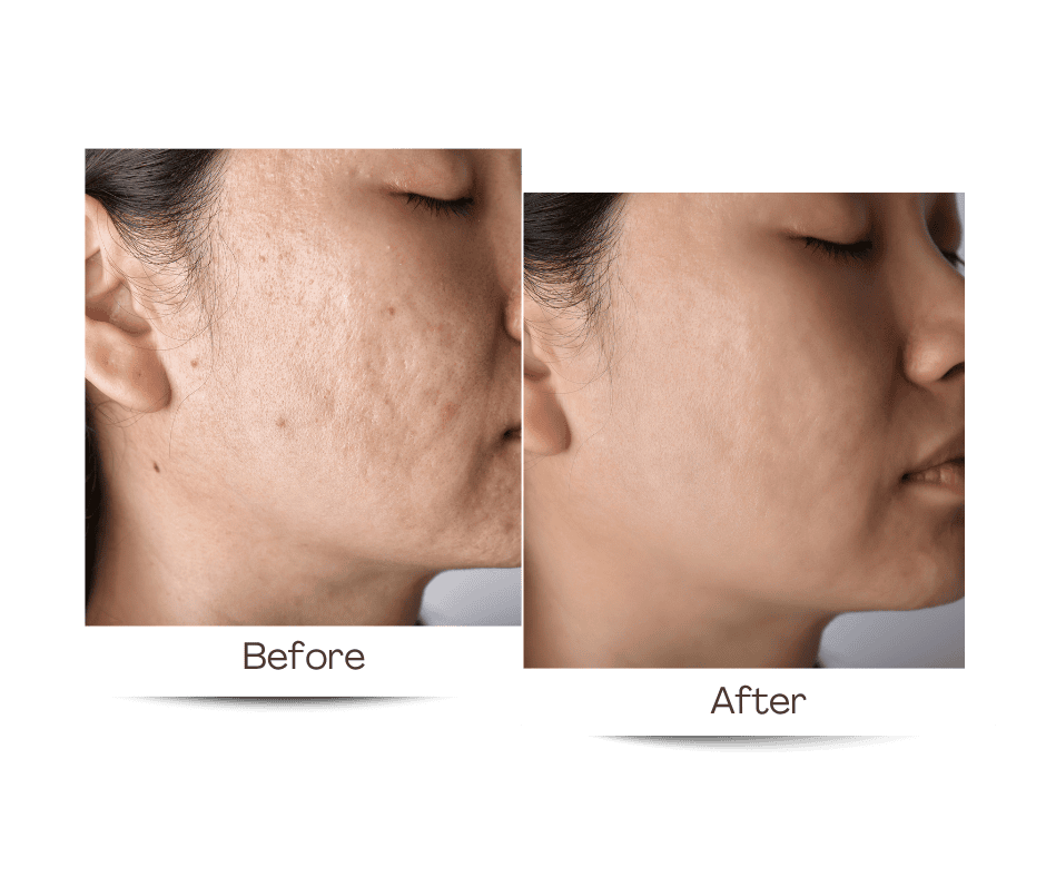 Microneedeling Before & After