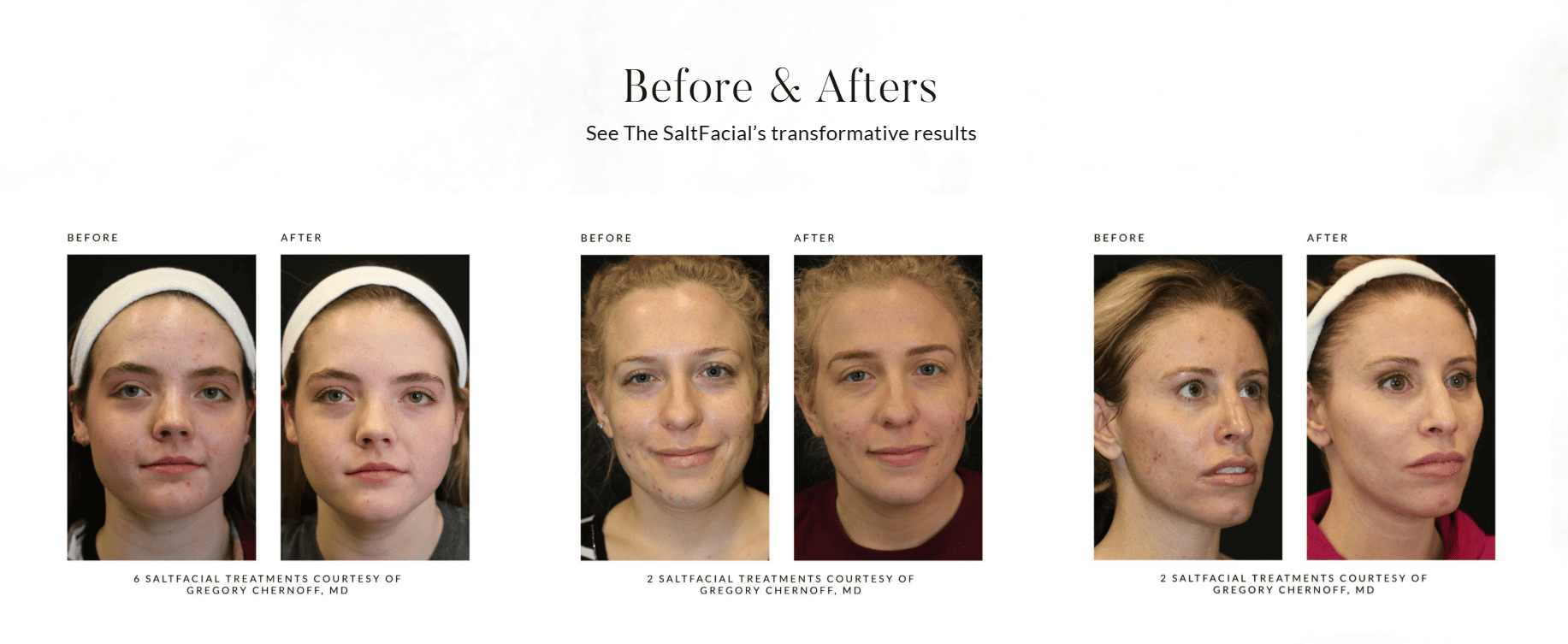 SaltFacial Before & After
