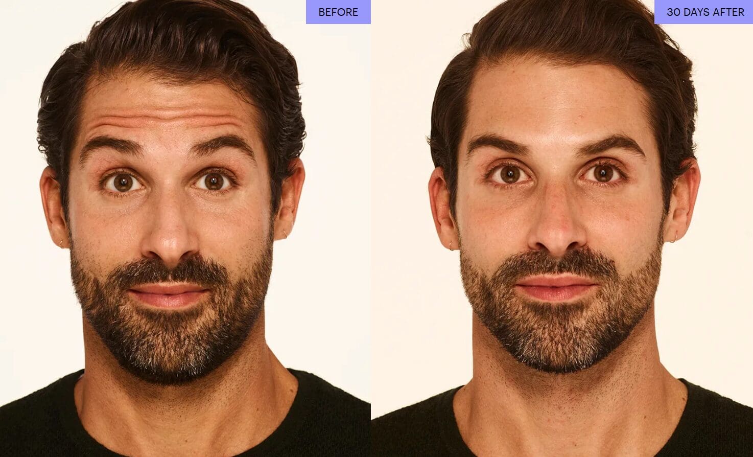 Botox Before and After