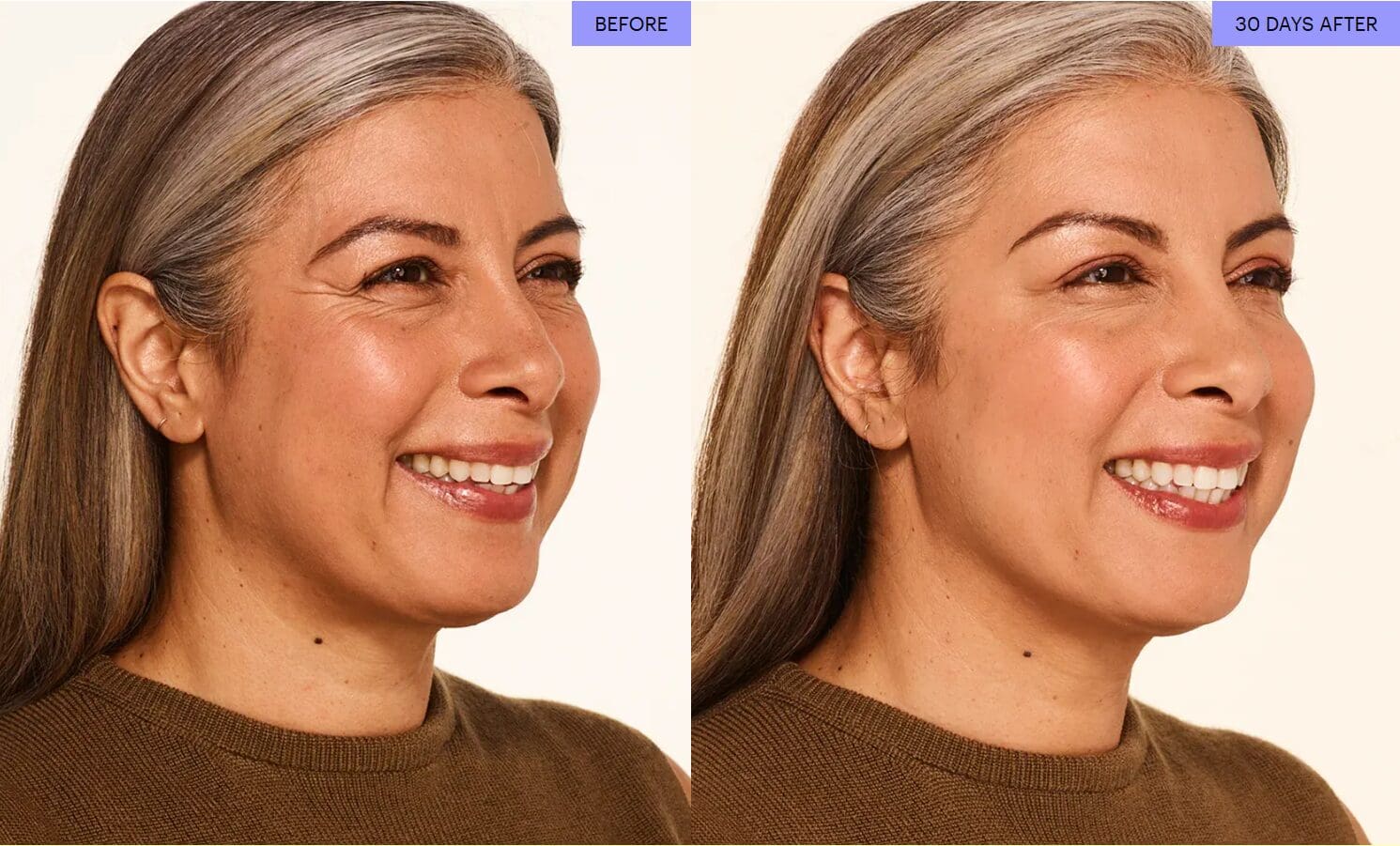 Botox before and after