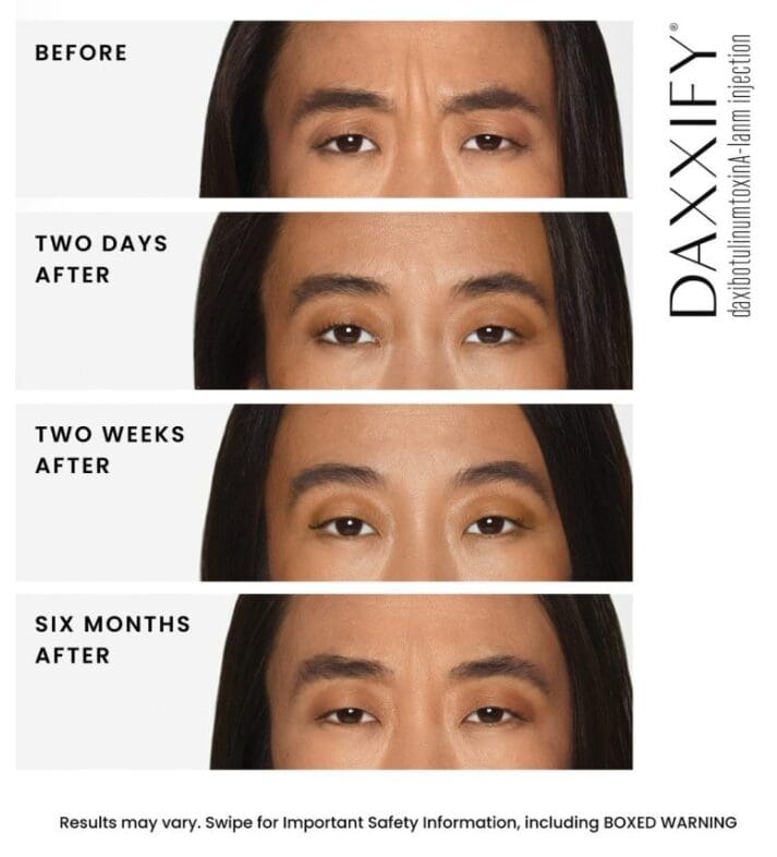Daxxify Before and After