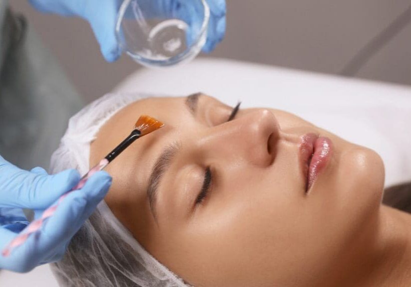 Chemical Peel