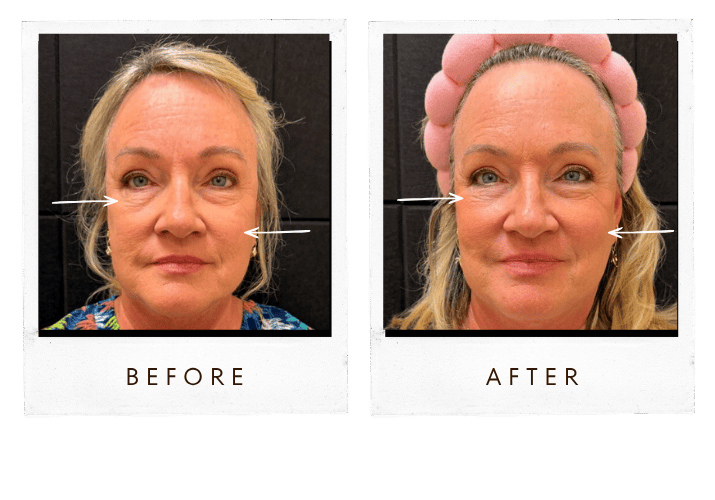 Under Eye Filler