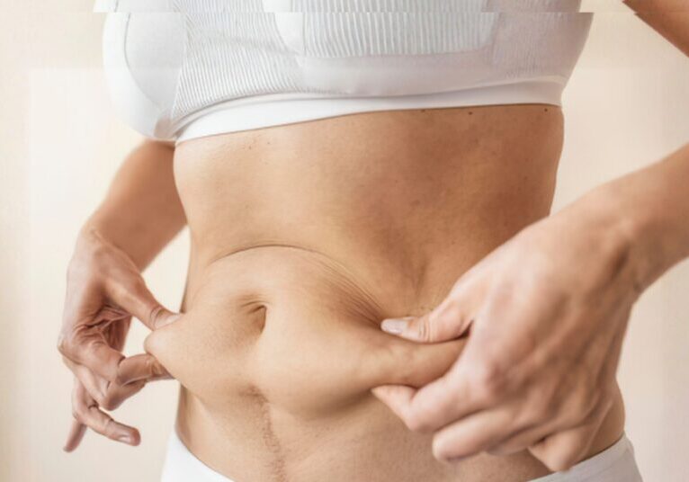 Skin Tightening After GLP-1