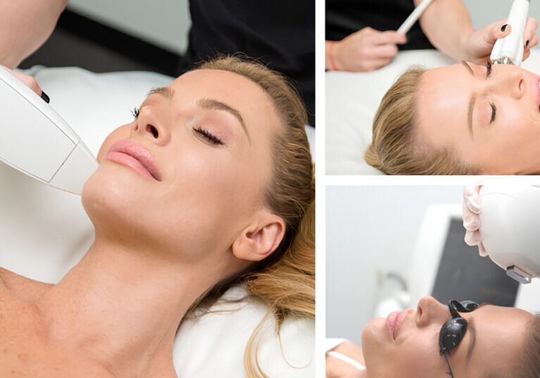 IPL Photofacial
